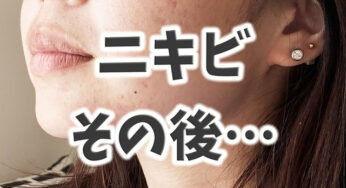 ニキビがなかなか治らない…結局、コレ。